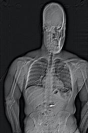 Body scan showing foreign objects believed to be stolen Tiffany diamond earrings